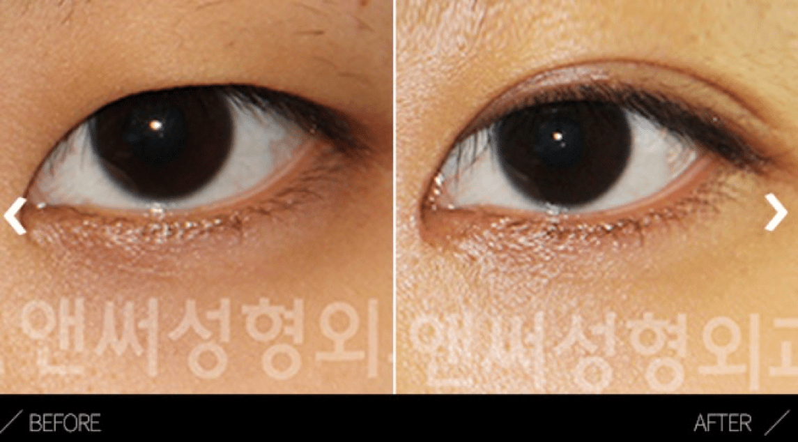 Non-incisional Double Eyelid Surgery  