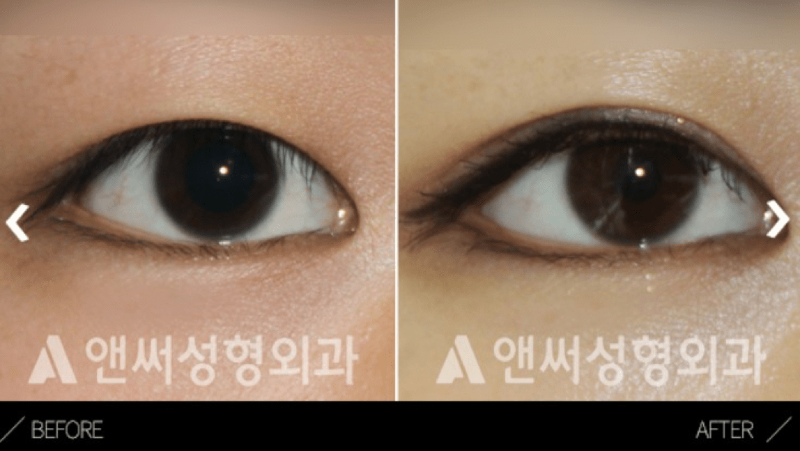 non incisional double eyelid