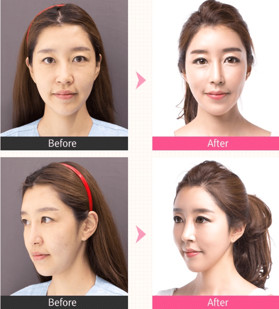 Fat Grafting, Facial Contouring, Rhinoplasty Before & After