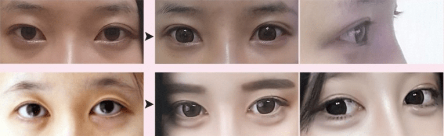 Partial Incisional Double Eyelid Surgery  