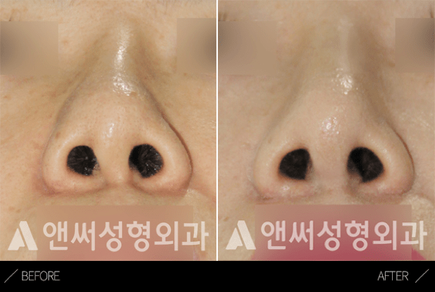Curved Nose Rhinoplasty