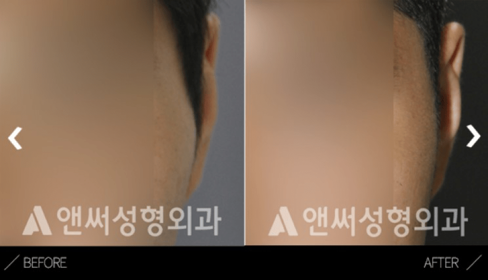 Cheekbone Reduction in Korea