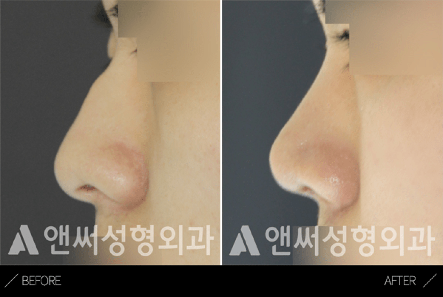 Hump Nose Removal