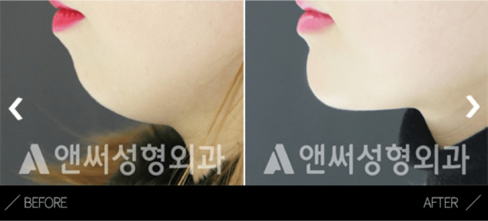 Forehead Implant In Korea