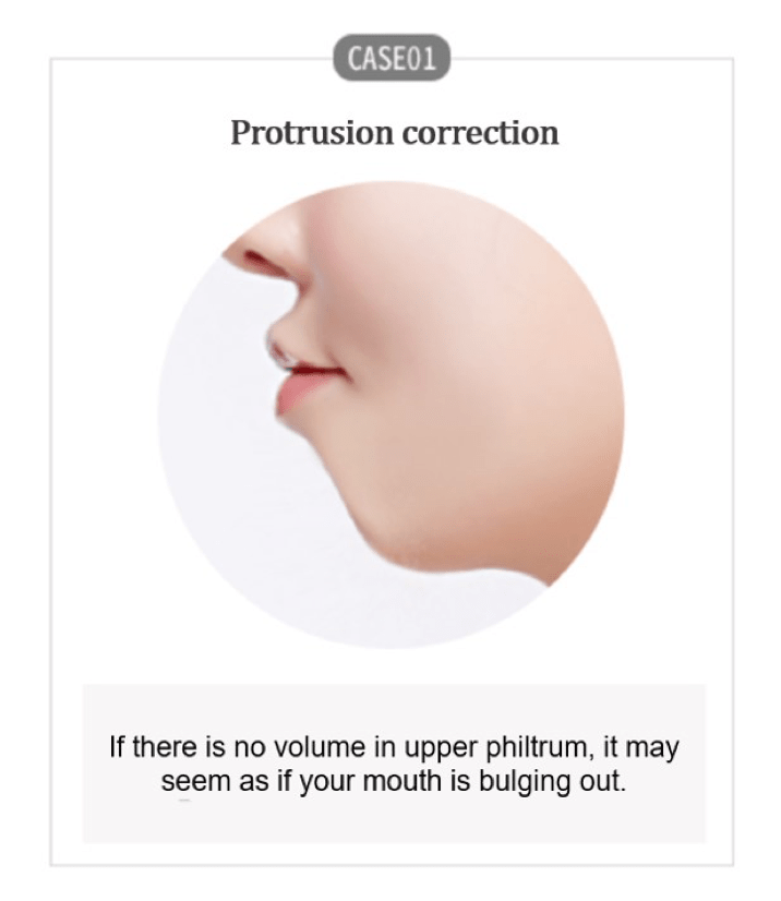 Protrusion correction
