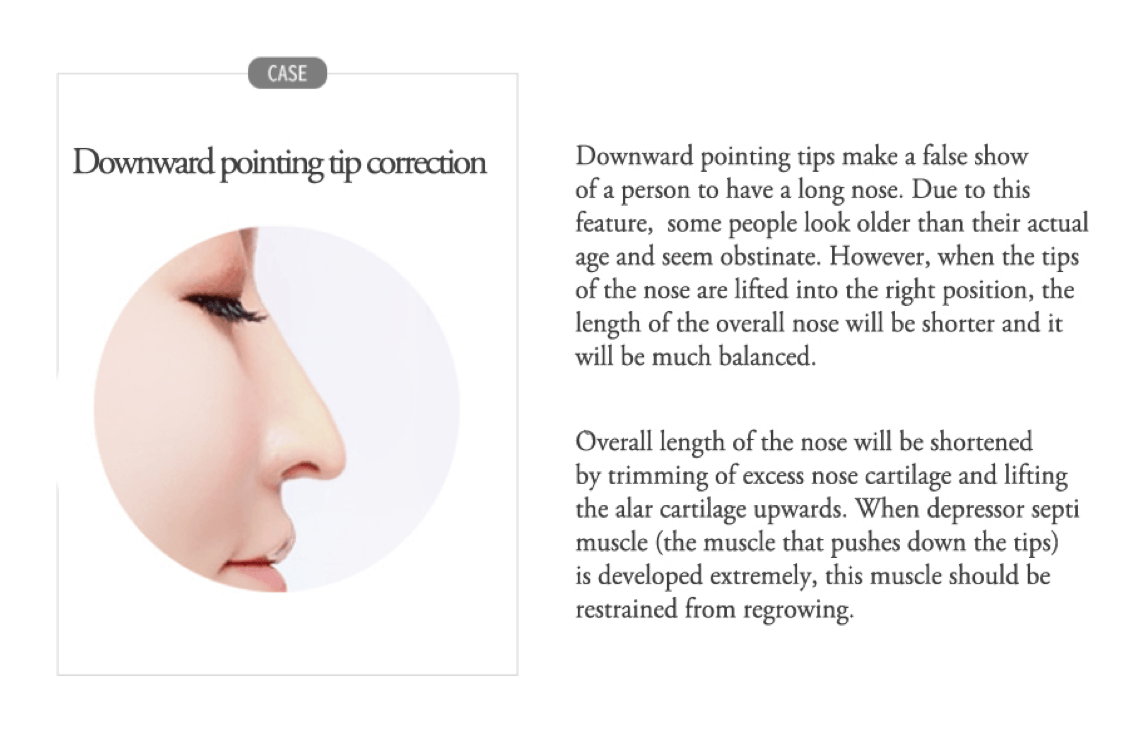 Downward Pointing Tip Correction