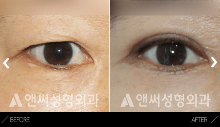 Lower Eye Blepharoplasty