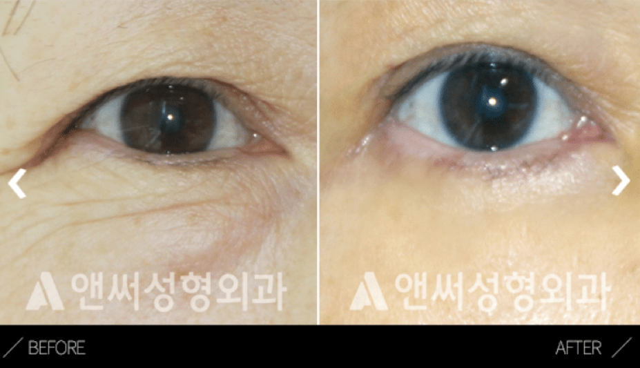 Lower Eye Blepharoplasty