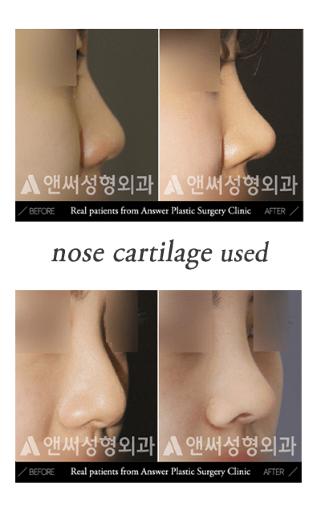 Rhinoplasty in Korea - Korean Nose Job Procedure
