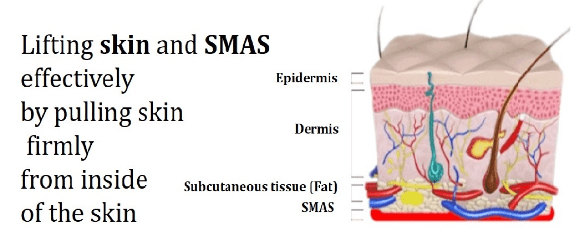 SMAS Lifting