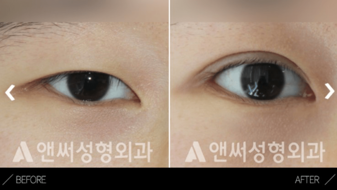 Lateral Canthoplasty in Korea