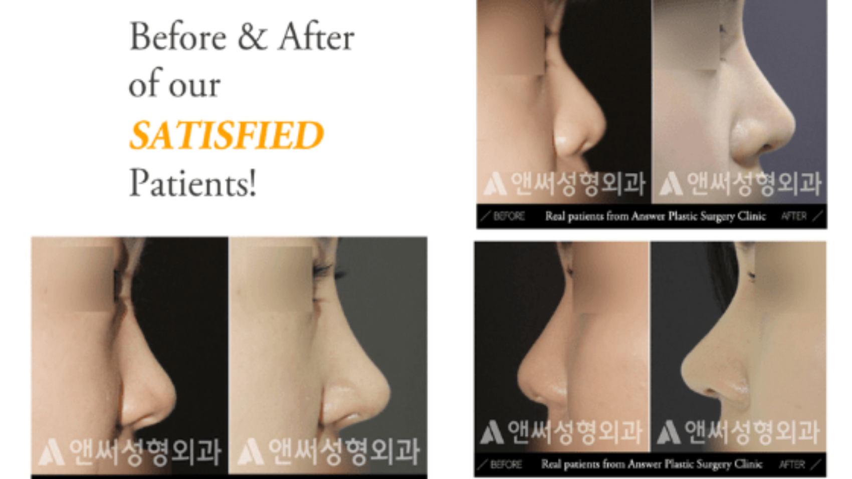 rhinoplastic surgery in korea