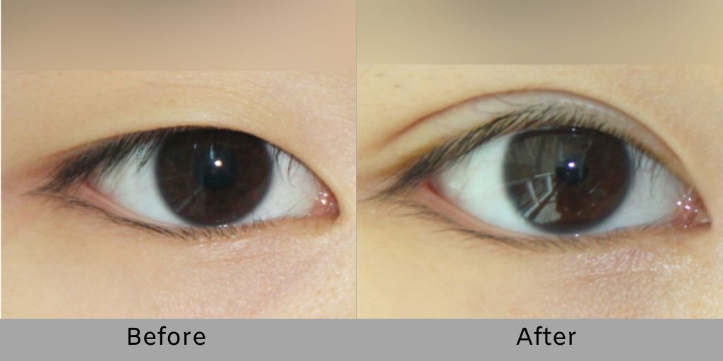 Non-incisional Double Eyelid Surgery   before and after