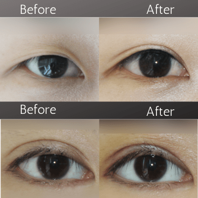 Revision Eye Surgery
