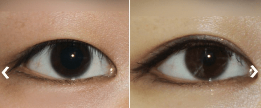 double eyelid surgery before and after picture