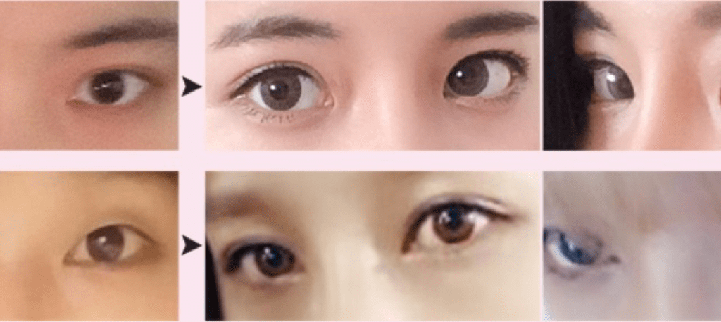 Double Eyelid Surgery in Korea - Definition, Procedure, Benefits, Recovery, Before and After