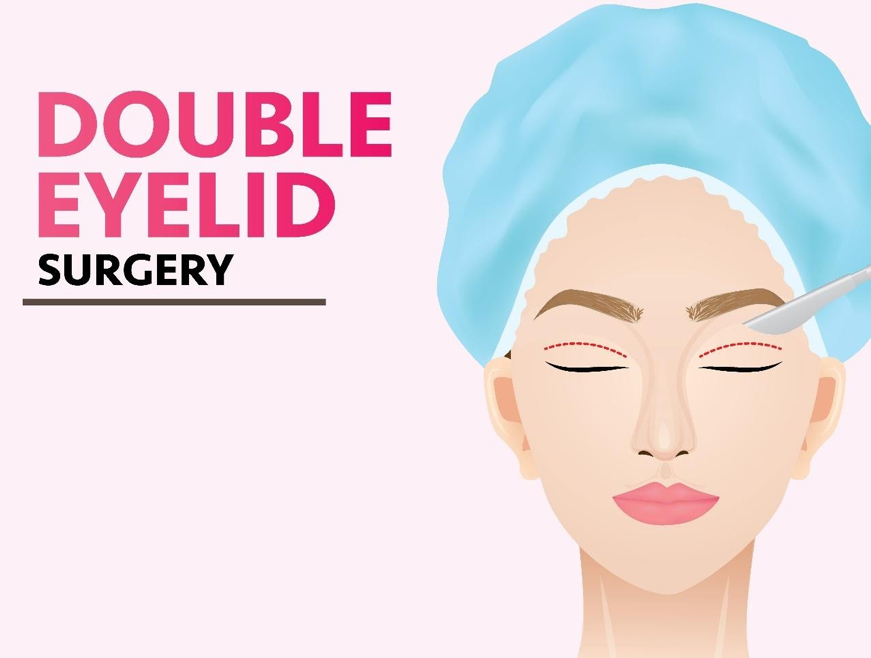 Double Eyelid Surgery in Korea - Definition, Procedure, Benefits, Recovery, Before and After