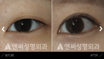 Incisional Double Eyelid Surgery
