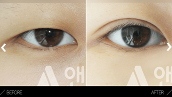 Partial Incisional Double Eyelid Surgery  