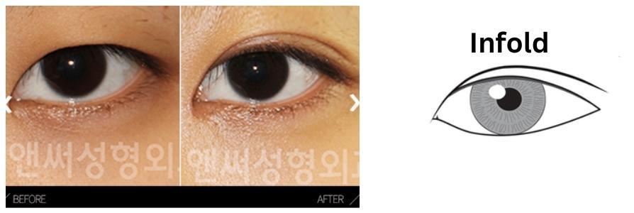 Partial incision double eyelid on sale surgery