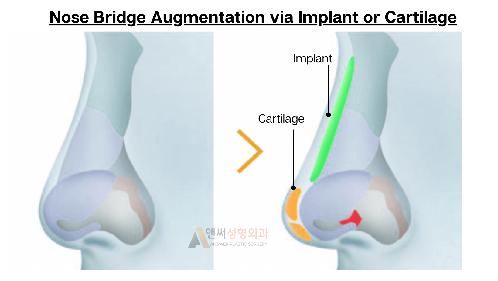 Nose Bridge Correction and Augmentation