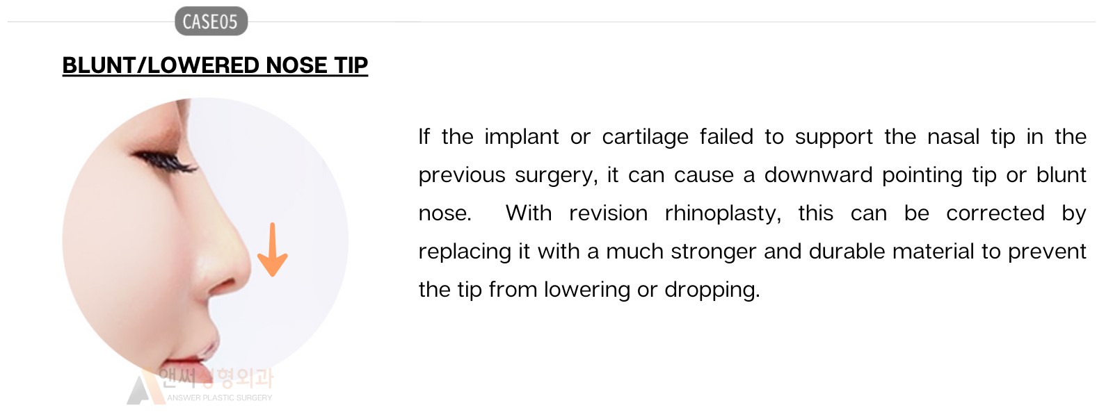 Nose Revision Surgery