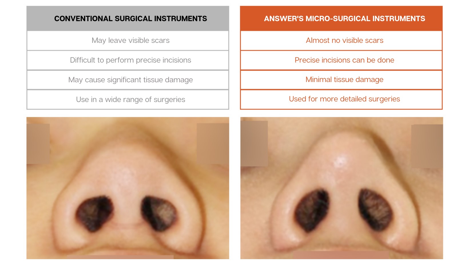 Nose Revision Surgery