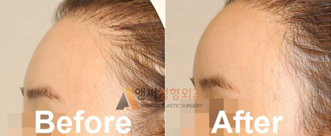 Forehead Implant Surgery