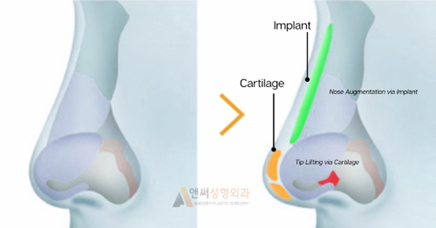 Why are Silicone Implants Usually Better than Cartilage Grafts When Enhancing the Nose Bridge?