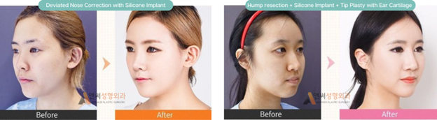 Why are Silicone Implants Usually Better than Cartilage Grafts When Enhancing the Nose Bridge?