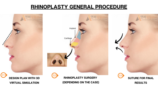 Rhinoplasty in Korea: Your 2024 Guide to Getting the Procedure